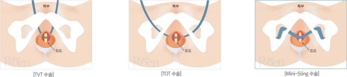 Mini-Sling 요실금 수술